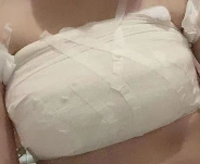 什么是隆胸？一文读懂手术原理、类型与适应人群