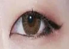 埋线双眼皮手术：快速变美，全程仅需30分钟至1小时！