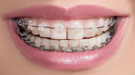 牙齿矫正会影响发音吗?一文解答你的所有疑虑!-55396