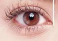 全切双眼皮“一术多效”：松弛、肿泡、不对称的终极解决方案