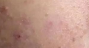 痘痘肌与牛奶的“微妙关系”:科学解析,饮品选择有妙招!