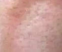 你知道你的毛孔为什么粗大吗?