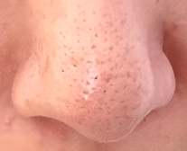 毛孔粗大不用愁,这些方法解你忧