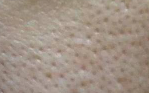 毛孔粗大怎么办？