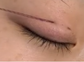 埋线双眼皮持久度大揭秘!2-5年效果如何最大化?