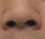 隆鼻术后鼻歪斜别慌！科学应对指南来了