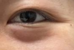 内切法眼袋手术：年轻人的“去袋”秘籍，无痕变美新选择！