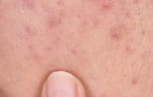 痘痘肌必看！甜食诱惑下如何守住肌肤健康防线？