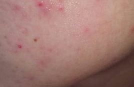 痘痘肌救星！维生素补充指南：吃对食物，告别反复长痘