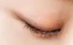 疤痕体质者必看！埋线双眼皮：美丽背后的风险与真相