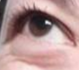 外切法去眼袋会留疤？真相与护理秘籍大公开！