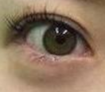 揭秘开内眼角：重塑双眸魅力的神奇手术