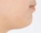 自体脂肪填充：自然变美的双刃剑，优缺点全解析！-55548