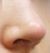鼻头矫正后假体移位别慌！手法复位VS二次手术，这样选才安心