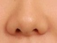 鼻头矫正效果大揭秘：永久维持还是定期补打？