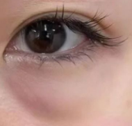 眼袋手术前必看！3大关键准备+避坑指南，让你安心变美不踩雷