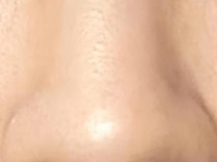 鼻头矫正术后揉鼻“红线”：3个月内这些动作千万别做！-55560