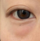 眼袋+泪沟“双重困扰”？一次手术双效解决，眶隔脂肪释放术了解一下！