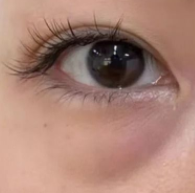 瘢痕体质想做眼袋手术？医生提醒：选对方法才能“无痕变美”！-55558