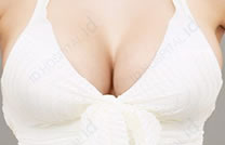 揭秘隆胸手术费用：数万到数十万的差距究竟差在哪？