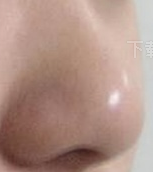 鼻炎患者鼻头矫正全攻略：不同鼻炎情况与手术时机大揭秘