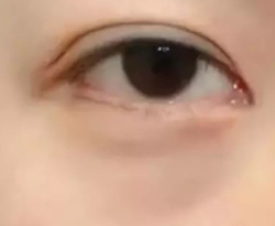 眼袋手术别大意！术后护理“黄金法则”助你快速恢复无痕美眼