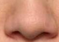 备孕必看！鼻头矫正术后多久能怀孕？医生给出明确时间线