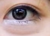 眼袋手术后下睑外翻？90%的人不知道的避坑真相！-55574