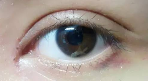 开内眼角后眼睛能“放大”多少？揭秘眼裂增长的神奇变化-55575