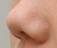 鼻翼矫正术前清洁全攻略：无菌生理盐水是关键，3步远离感染风险！