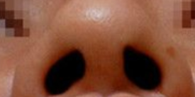 女性生理期做鼻翼矫正手术？这些风险你一定要知道！