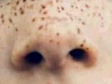 揭秘雀斑“元凶”：遗传与紫外线如何联手“作怪”？