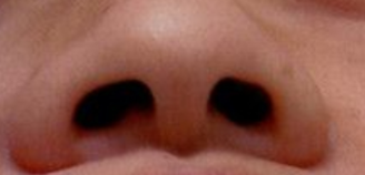 鼻翼内收术后护理全攻略：鼻夹板佩戴时间、姿势禁忌一次说清！-55593