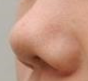 鼻翼外展术全解析：是否需要取软骨？材料选择与效果一次说清！