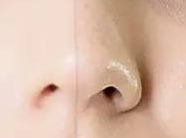 注射除皱后侧睡有风险？术后1周平躺睡觉才是关键！