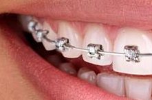 牙齿矫正全揭秘：开启自信笑容的蜕变之旅