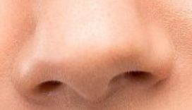 复杂鼻翼矫正必看！分阶段手术+鼻模塑形，才是安全变美的“黄金公式”？