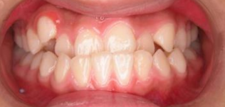 保持器清洁全攻略：清水冲洗还是假牙片浸泡？避开高温变形陷阱！