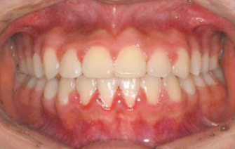 保持器丢失别慌！3步紧急应对指南：联系医生+防反弹+快速补救