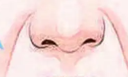 法令纹大解密：动态、静态与假性法令纹的改善秘籍！