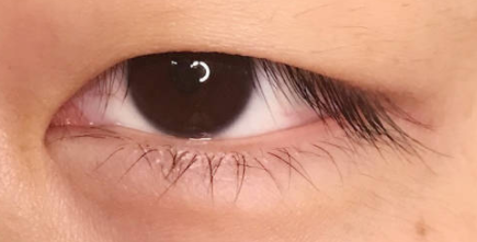 功能性眼型矫正大揭秘：这些眼部问题不容忽视！