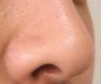 鼻翼矫正术后拆线全攻略：时间、护理与注意事项-55617