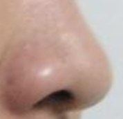 鼻翼矫正术后变美攻略：洗脸化妆时间大揭秘！