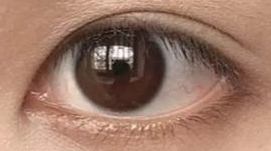 全切双眼皮术后形态不满意？别急，完全恢复后可二次调整！