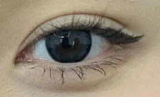 全切双眼皮技术大革新！内窥镜辅助成主流，创伤小、恢复快，效果更惊艳-55642