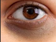 维生素E胶囊涂眼周：可行但需谨慎操作