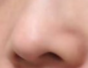 鼻翼矫正术后消肿指南：科学护理，加速恢复