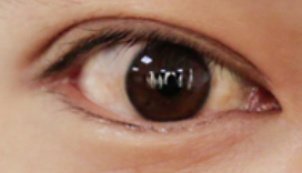 揭开白内障的神秘面纱-55659