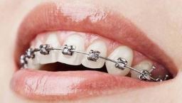 矫正后牙齿会更容易脱落吗？规范矫正护牙周，远离脱落风险