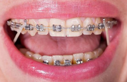 矫正能改善笑容吗？科学调整，解锁自信微笑新可能